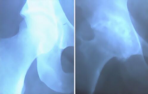 Ненависть артроза коленного сустава